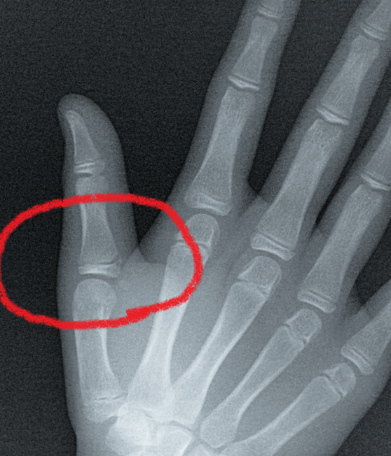 指の骨折